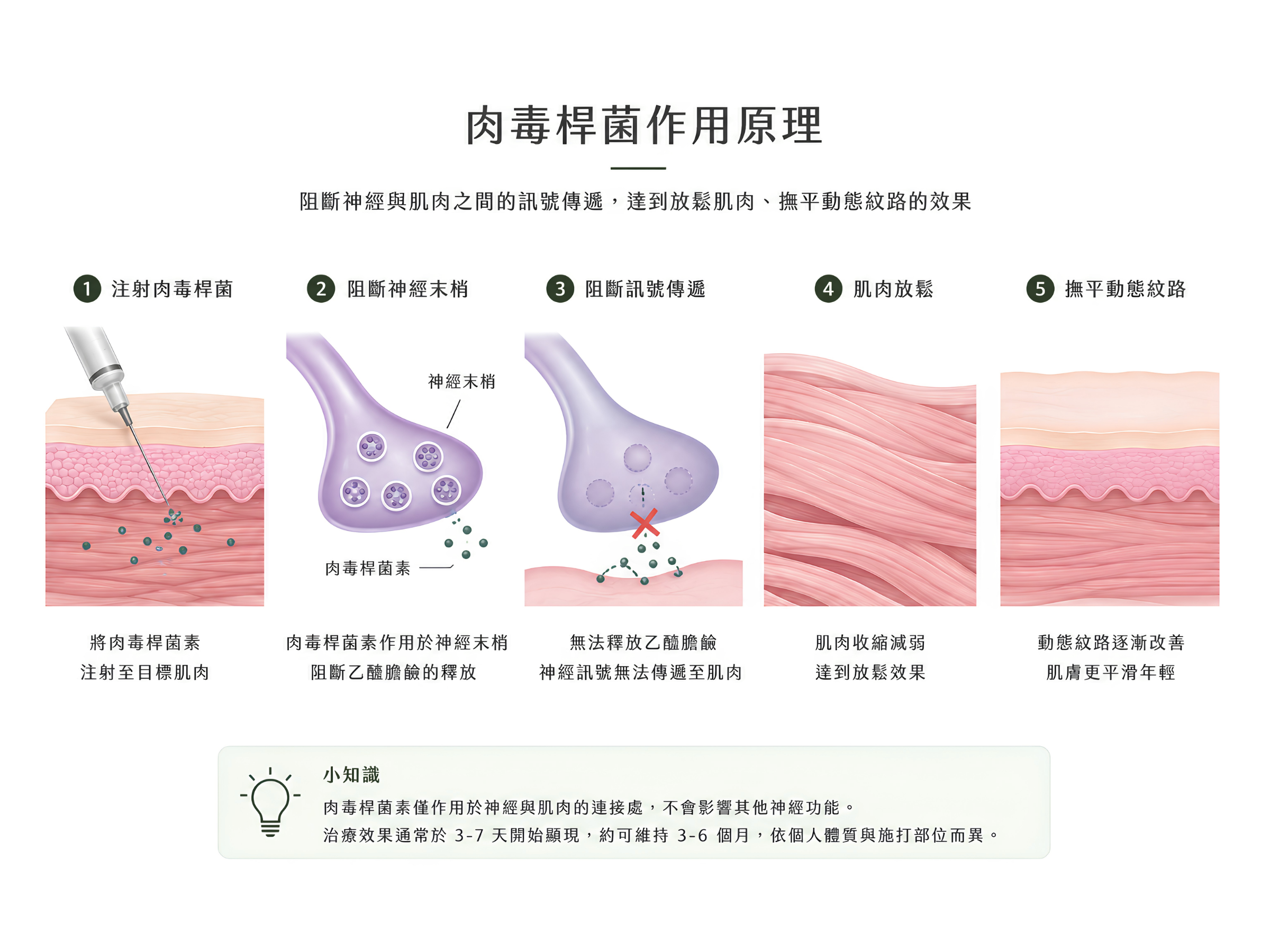 肉毒桿菌素，是由肉毒桿菌所提煉出的一種蛋白質神經毒素，它作用在神經與肌肉或腺體的接合處，使肌肉放鬆或抑制腺體分泌。透過肉毒桿菌素注射，可減少肌肉過度運動，輔助改善紋路平滑，並預防新紋路形成。